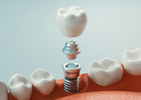 Kadıköy İmplant Tedavisi - Moyedent - Moyedent Diş Kliniği