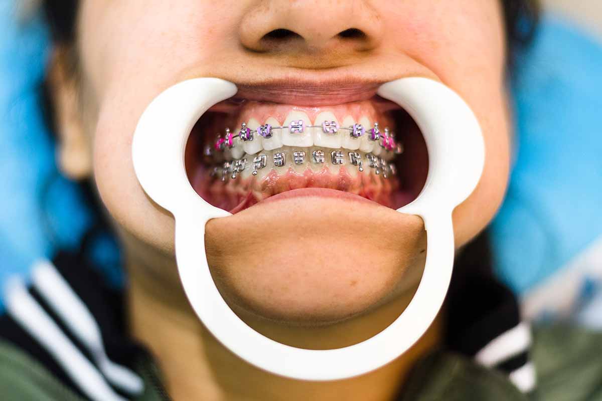 Kadıköy Lingual Ortodonti - Moye Ağız ve Diş Sağlığı Polikliniği