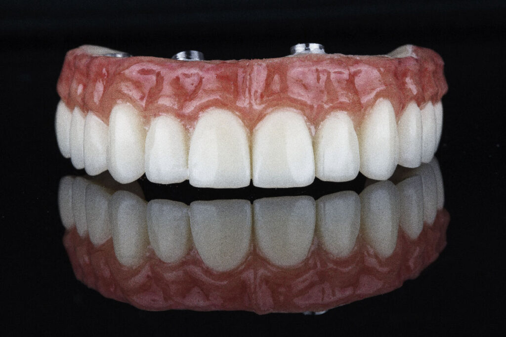 Kadıköy Moyedent kliniğinde sergilenen sabit ve hareketli implant üstü protez seçeneklerinin karşılaştırmalı görünümü.